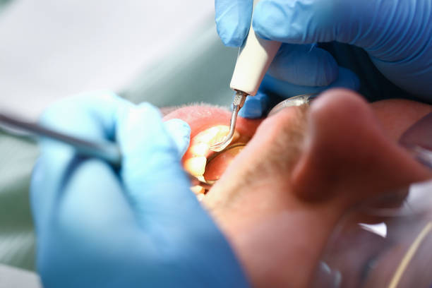 Best Emergency Wisdom Teeth Removal in Montrose, MI