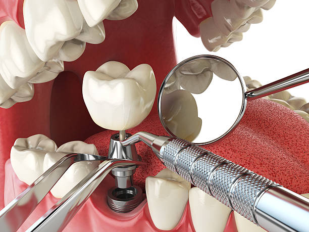 Best Emergency Dental Care for Broken or Chipped Teeth in Montrose, MI