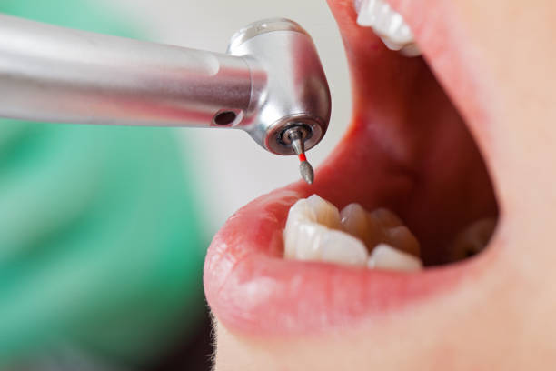 Best Emergency Tooth Extraction in Montrose, MI